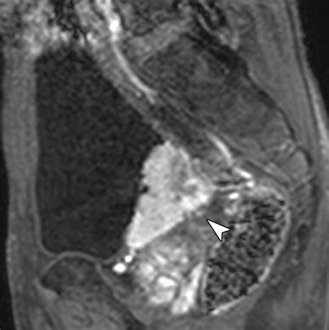 Urinary Bladder Cancer Diffusion Weighted Mr Imaging—accuracy For