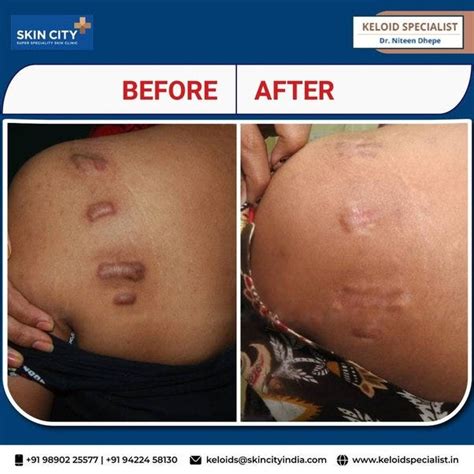 Dr Niteen Dhepe A Keloid Specialist In Pune Provides A Wide Range Of Keloid Scar Removal