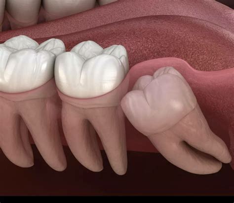 Denti Del Giudizio Studio Dentistico Simeoni