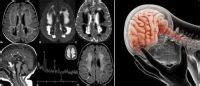 Leucoencefalopat A Qu Es Signos S Ntomas Causas Trastornos