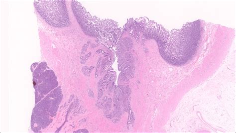 Ampulla Of Vater Histology