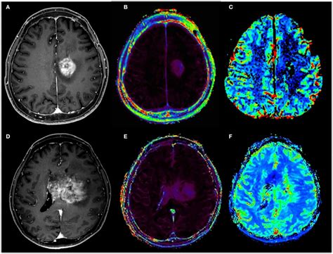 Pseudoprogression And Recurrence Of Glioblastoma GBM In Patient 1