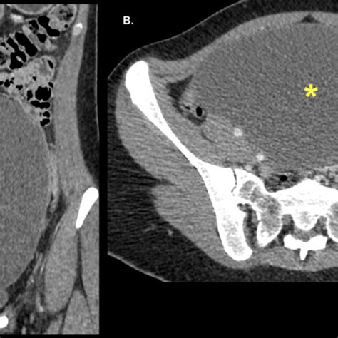 Mucinous Cystadenoma In A 26 Year Old Woman Ct Coronal A And Axial