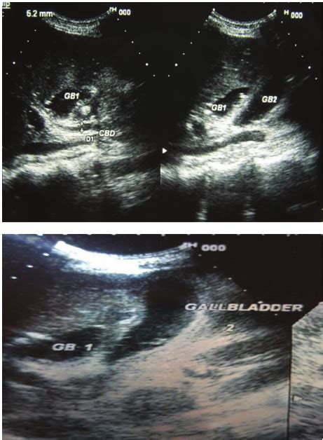 Usg Showing Duplication Of The Gallbladder Download Scientific Diagram