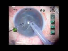 Facoemulsificaci N E Implante De Lente Intraocular Youtube