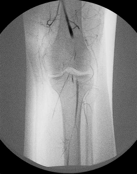 Popliteal Artery Disease Diagnosis And Treatment Radiographics