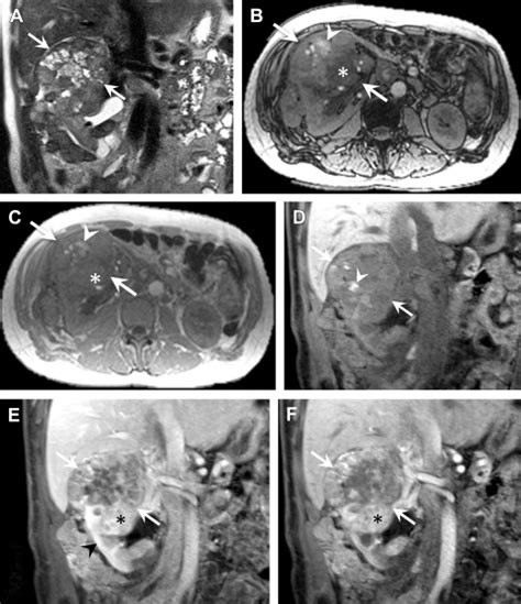 Imaging Of Solid Renal Masses Radiologic Clinics