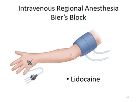 Simple Analgesia And Local Anaesthetics Y3 Pharm Flashcards Quizlet