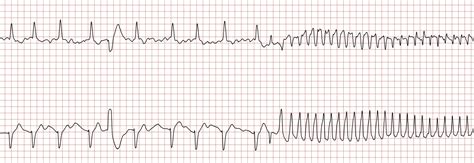 Sudden Cardiac Arrest Case 6 The Cardiovascular