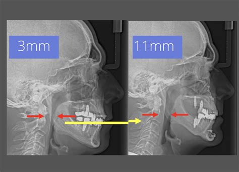 Underbite Surgery Xray