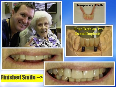 Dental Implants In Pasadena Texas With Dr Michael Nugent Dr Nugent