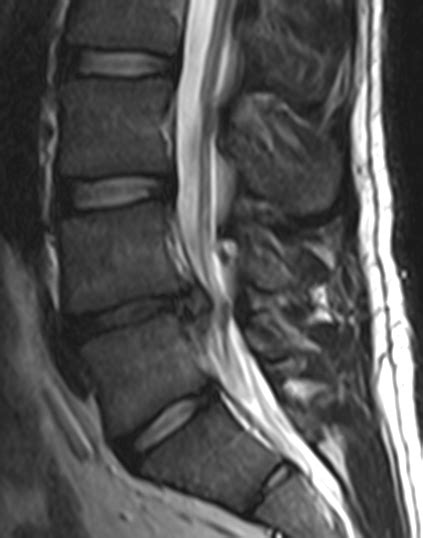 File:L4-l5-disc-herniation.png - Wikipedia