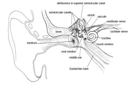 superior semicircular canal dehiscence sscd vestibular disorders