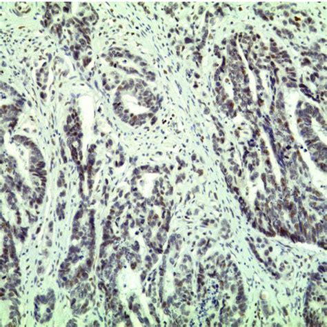 Immunohistochemical Staining For Er In Colorectal Cancer Tissue