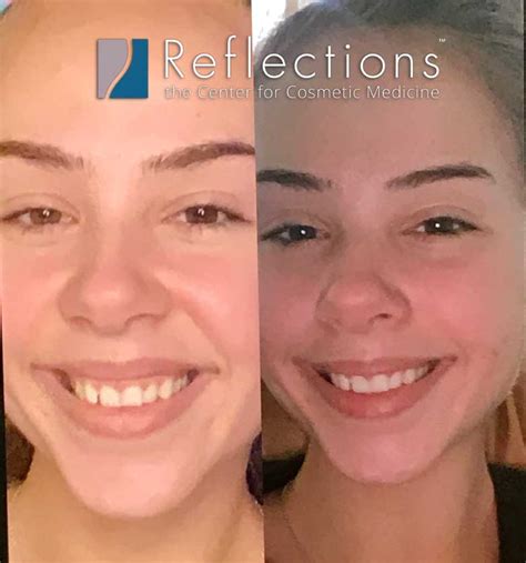 Gummy Smile Makeover With Botox Injections For 20 Year Old Woman Before And After Photos New