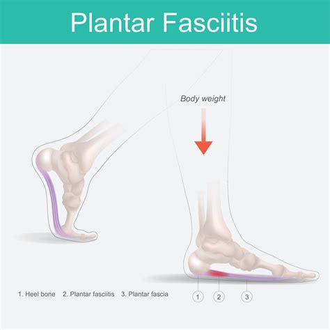 Effective Stretches And Exercises For Plantar Fasciitis Relief