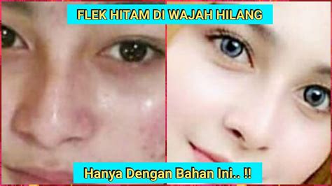 Cara Menghilangkan Bintik Hitam Di Wajah Cara Menghilangkan Flek Hitam Secara Alami Dengan