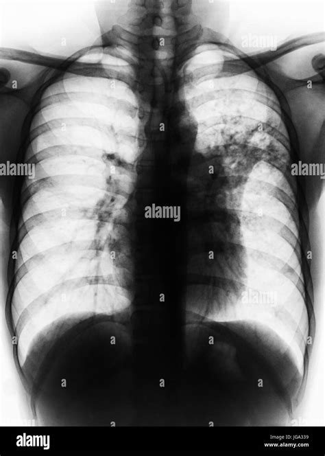 Pulmonary Tuberculosis Film Chest X Ray Show Alveolar Infiltrate At