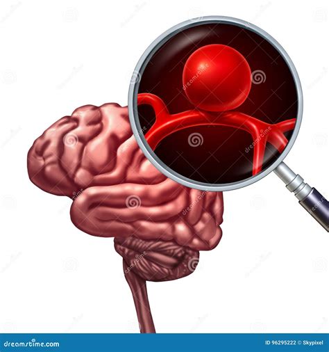 Brain Aneurysm Concept Stock Illustration Illustration Of