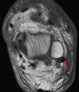 Mri Findings Of Peroneal Tendon Pathology Sports Medicine Review