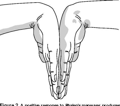 Tinel's Sign and Phalen's Maneuver: Physical Signs of Carpal Tunnel ...