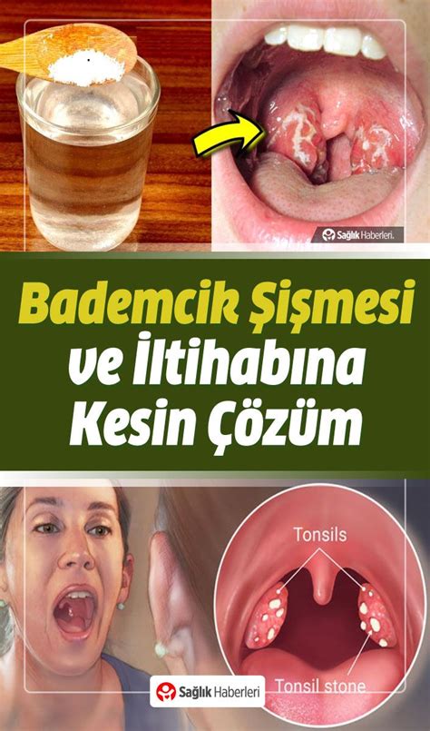 Bademcikler neden şişer Bademcik iltihabı ve şişmesine ne iyi gelir