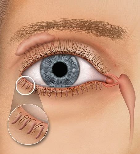 Meibomian Gland Dysfunction Central Maryland Eye Associates