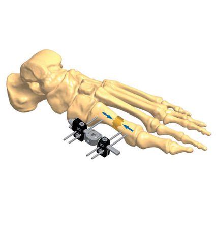 Nonunion Foot Fracture Treatment Orthofix Abs