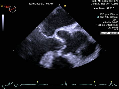 AI And 4D TEE In Aortic Valve Disease