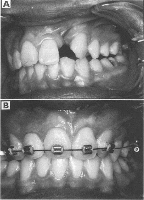 A Before And B After Alveolar Bone Graft Occlusion Showing Cleft