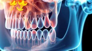 Wisdom Teeth X-ray: What to Expect and Why It's Important