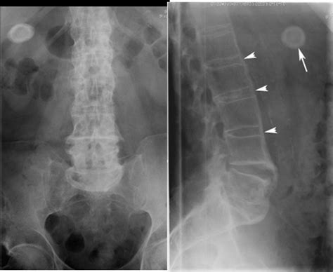 Gallstones Xray