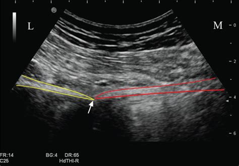 Diagnostic Block Of The Pudendal Nerve Under Ultrasound Guidance A