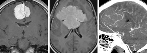 Parafalcine Meningioma The Neurosurgical Atlas By Aaron Cohen Gadol