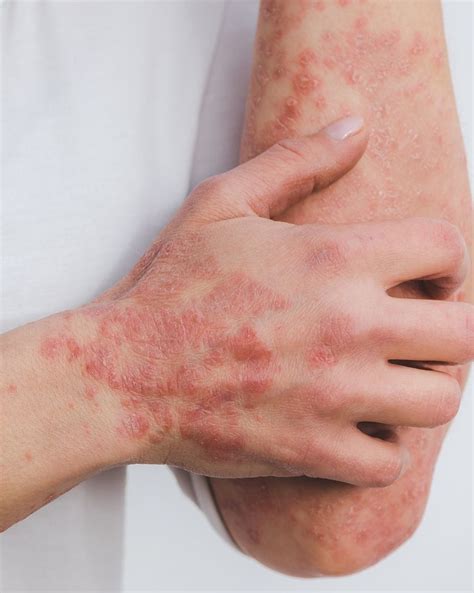 Psoriasis Traitements Naturels Pour Soulager Les Sympt Mes Femininbio