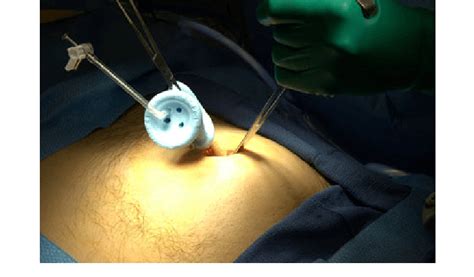 Insertion Of A Single Incision Laparoscopic Surgery Sils Port Using A