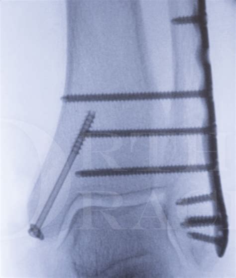 ankle fracture fibula pro tibia fixation technique  stryker