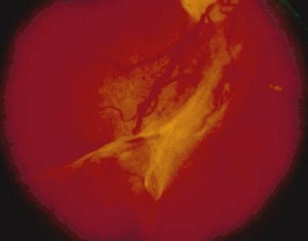 Moran Core Retina Rpe Histopathology