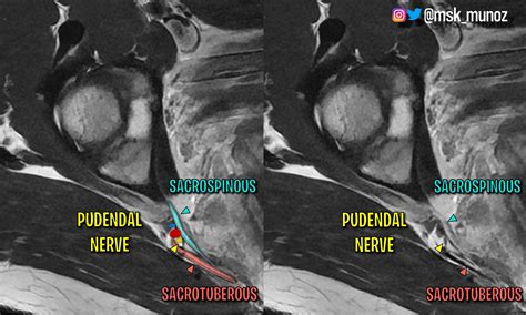 Pudendal Nerve Mri