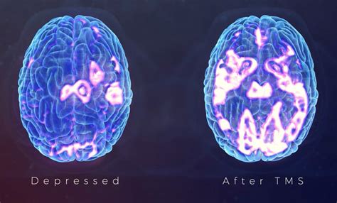 How Tms Works Clearwave Mental Health