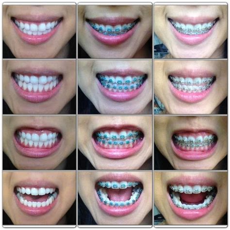 braces color ideas for adults - Intelligent Binnacle Gallery Of Photos