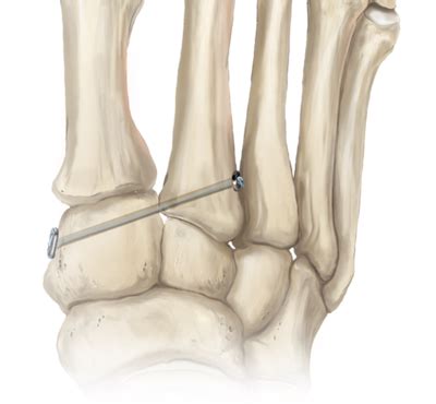 Arthrex - Lisfranc Injury Fixation