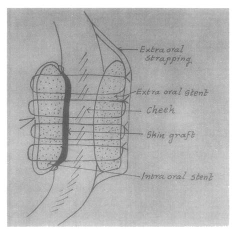 Diagrammatic representation of sandwich technique. | Download ...