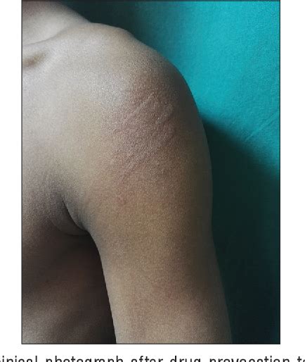 Figure 1 From A Rare Case Of Rifampicin Induced Urticaria Confirmed By Drug Provocation Test