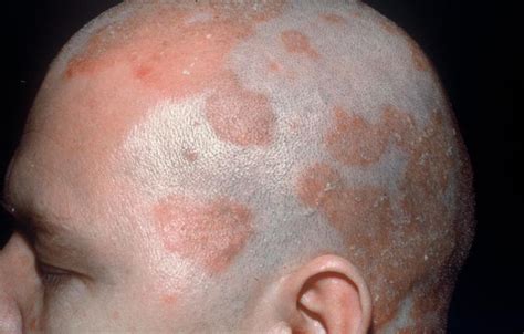 Seborrheic Dermatitis (Seborrhea) - Symptoms and Treatment | Health Care «Qsota»