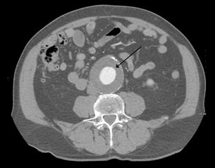 Aneurismas Arteriales T Cnicas Endovasculares Para Su Tratamiento