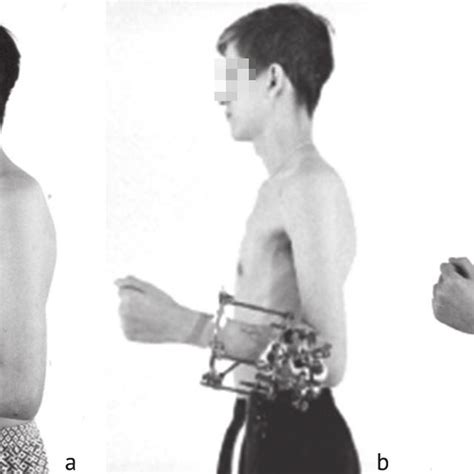 A Yearold Patient With Chronic Anterior Medial Dislocation Of The