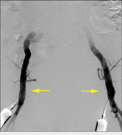 Bilateral Common Femoral Artery Percutaneous Access Yellow Arrows On