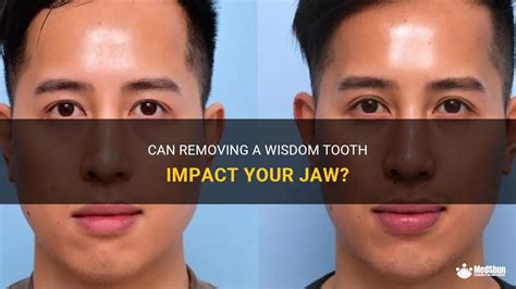 Can Removing A Wisdom Tooth Impact Your Jaw Medshun