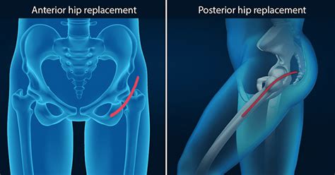 Difference Between Anterior and Posterior Hip Replacement - Differences ...